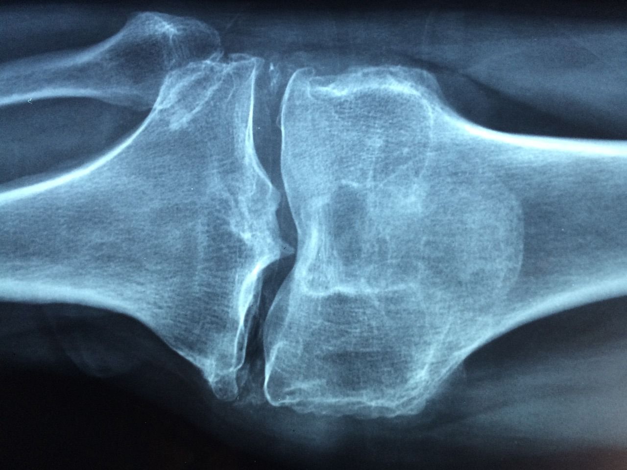 spondilita anchilozanta boala autoimuna meniscus afectarea gradului 2 al tratamentului articulației genunchiului